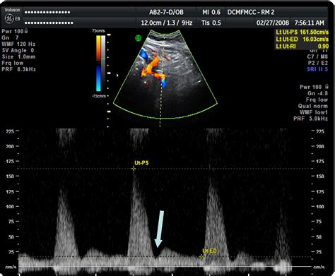 Uterine artery Doppler flow studies in obstetric practice